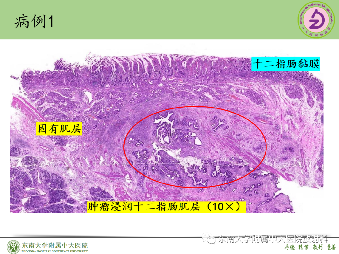 影像PPT - 【PPT】理影外合——胰腺癌-26