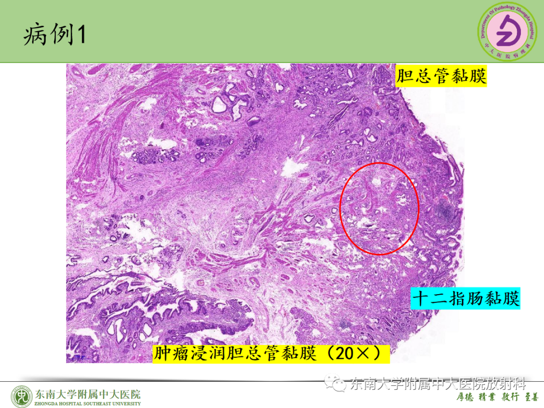 影像PPT - 【PPT】理影外合——胰腺癌-27