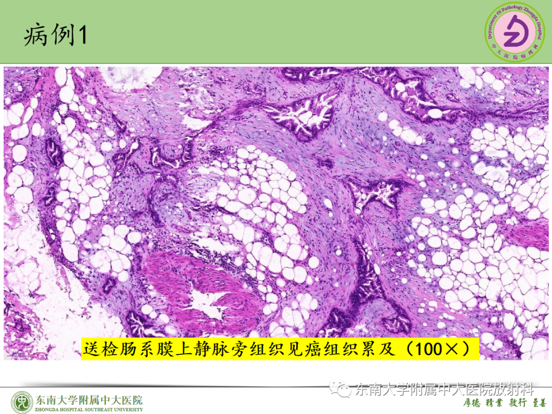 影像PPT - 【PPT】理影外合——胰腺癌-28