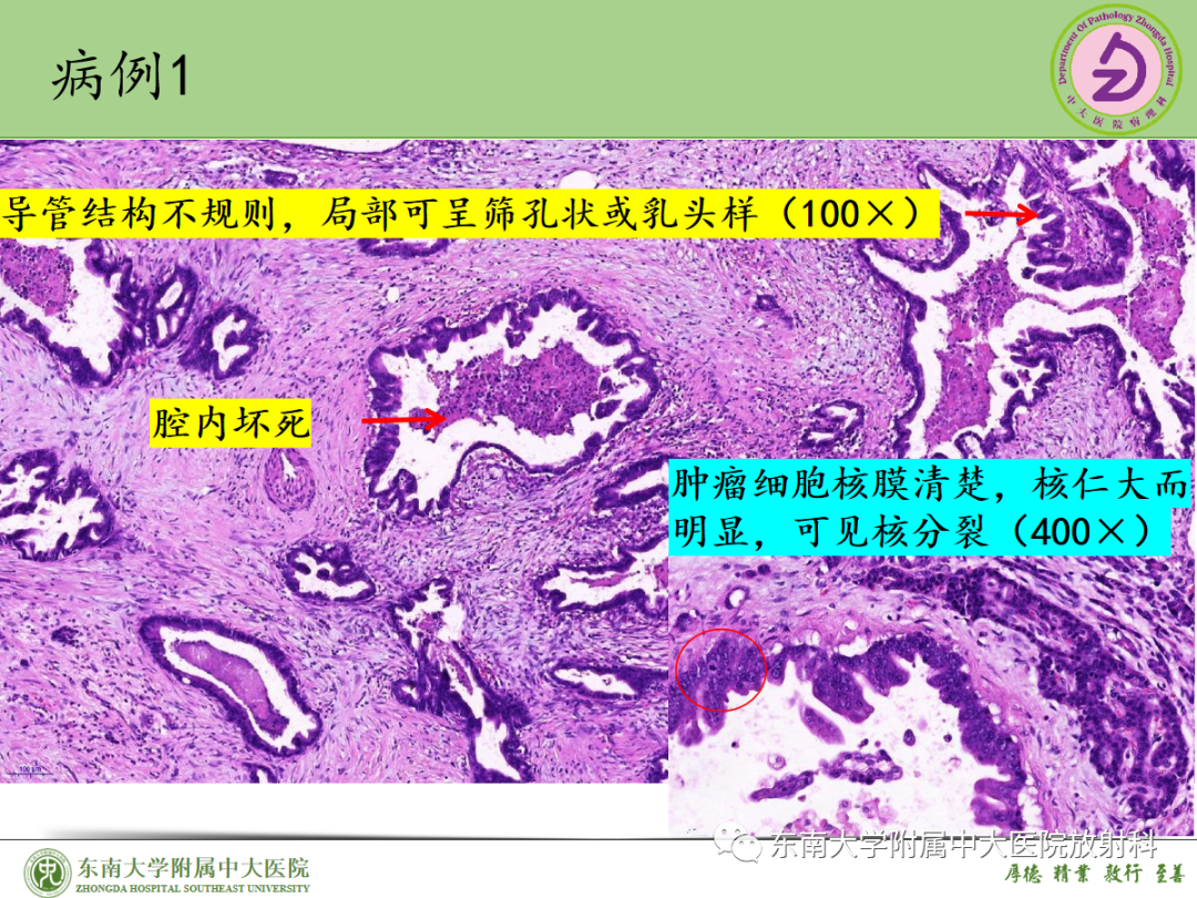 影像PPT - 【PPT】理影外合——胰腺癌-29