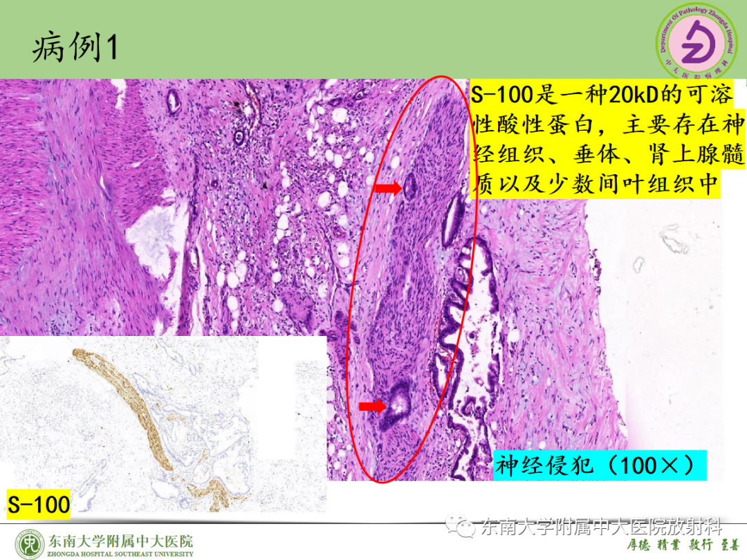 影像PPT - 【PPT】理影外合——胰腺癌-30