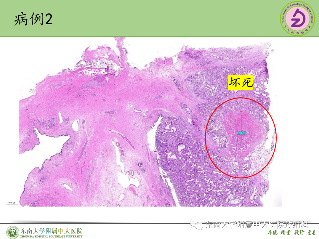 影像PPT - 【PPT】理影外合——胰腺癌-34