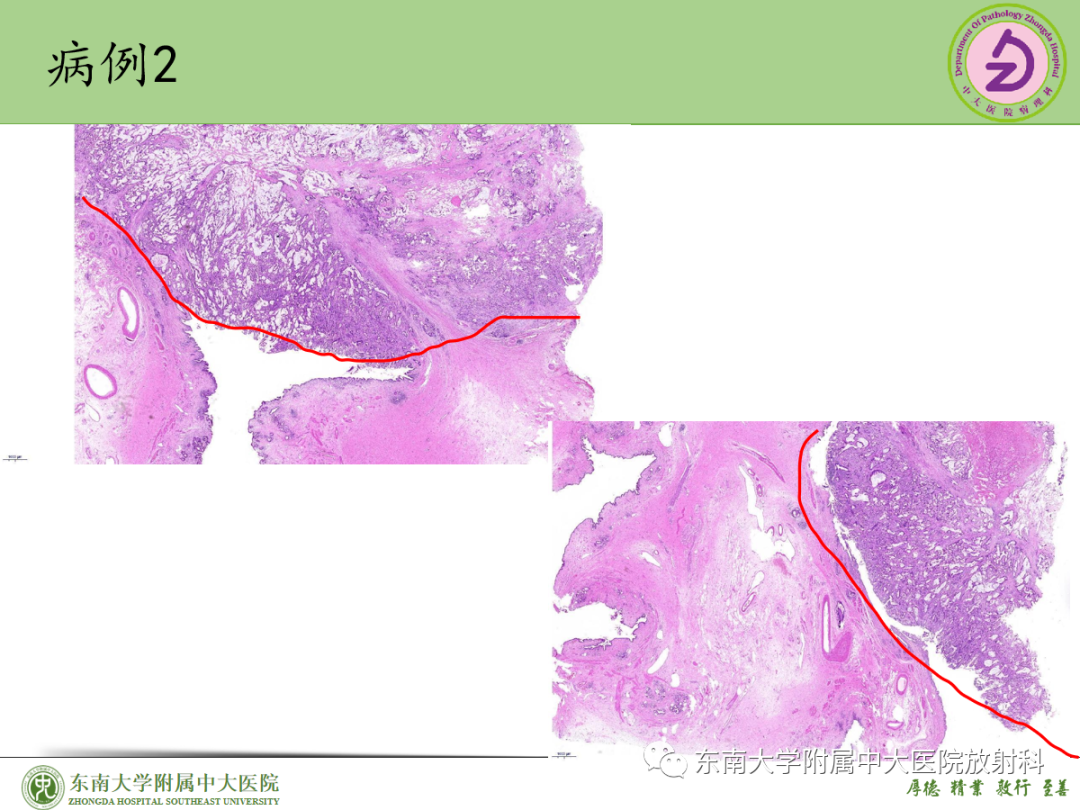 影像PPT - 【PPT】理影外合——胰腺癌-35