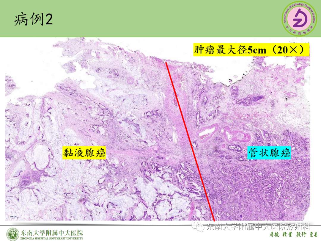 影像PPT - 【PPT】理影外合——胰腺癌-36