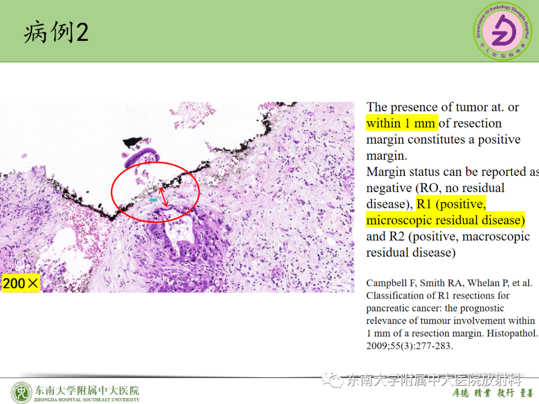 影像PPT - 【PPT】理影外合——胰腺癌-37