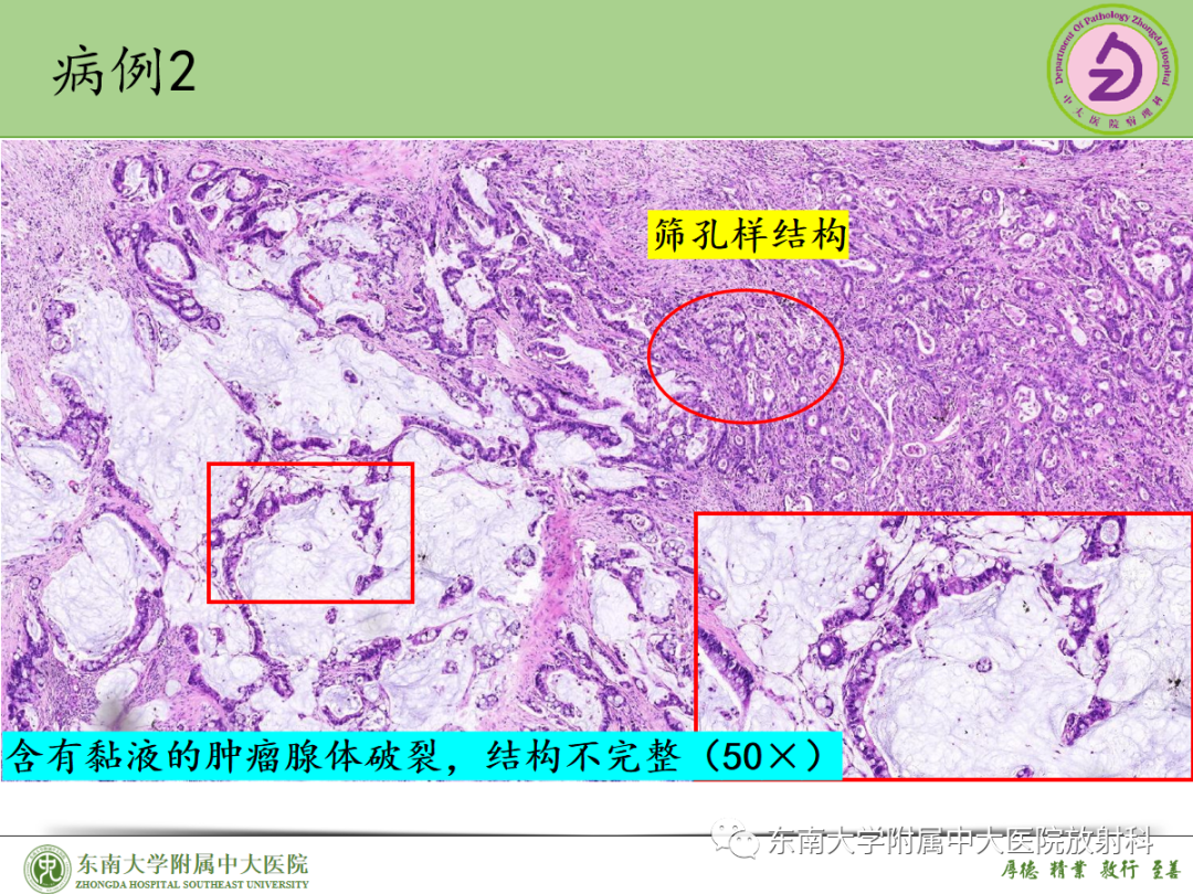 影像PPT - 【PPT】理影外合——胰腺癌-38