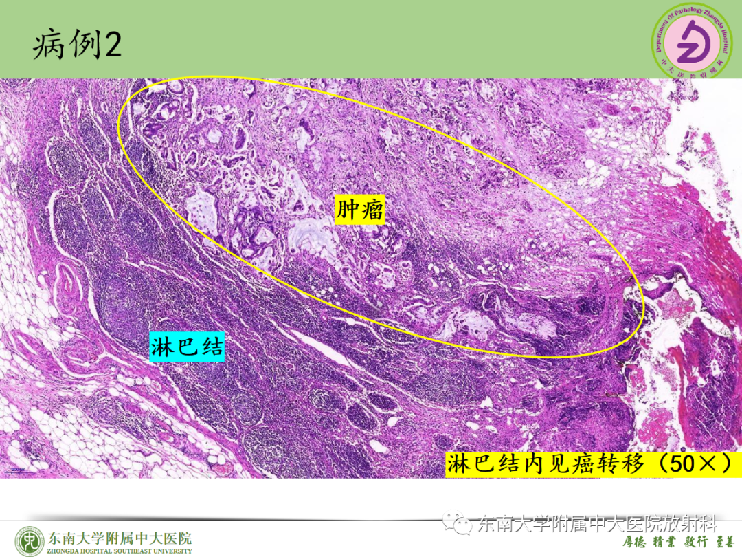 影像PPT - 【PPT】理影外合——胰腺癌-39