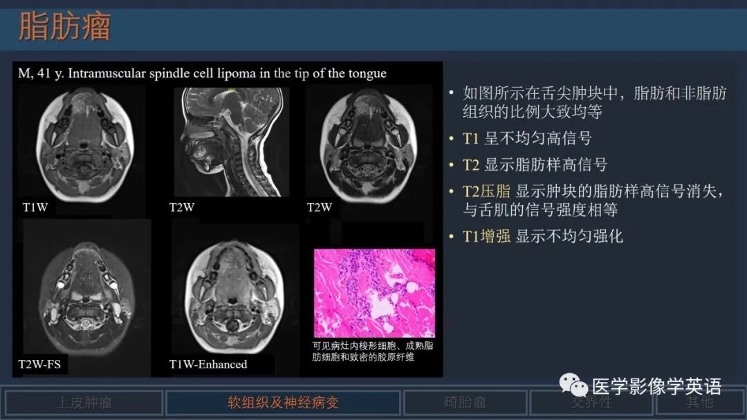 影像PPT - 【PPT】舌良性肿瘤及肿瘤样病变的MR表现及影像与病理对照分析-19 影像PPT - 【PPT】舌良性肿瘤及肿瘤样病变的MR表现及影像与病理对照分析-19