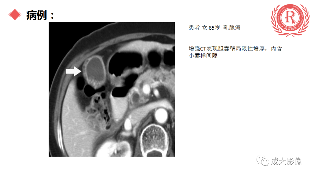 影像PPT - 【PPT】胆囊腺肌症-8