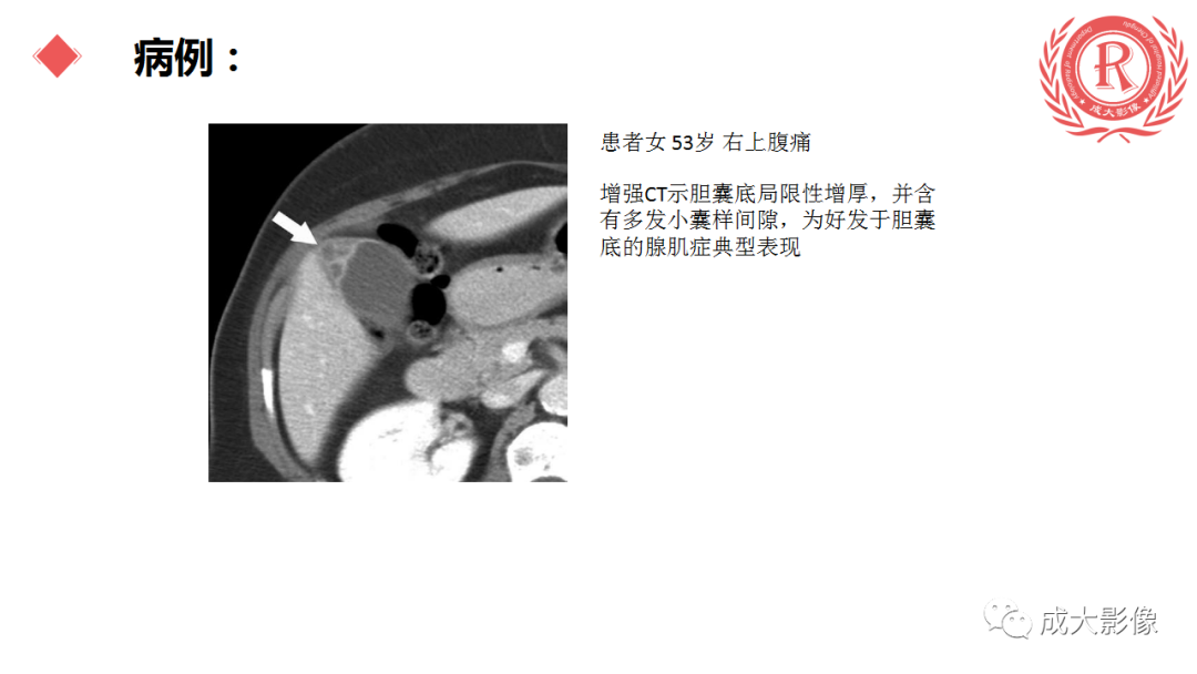 影像PPT - 【PPT】胆囊腺肌症-10