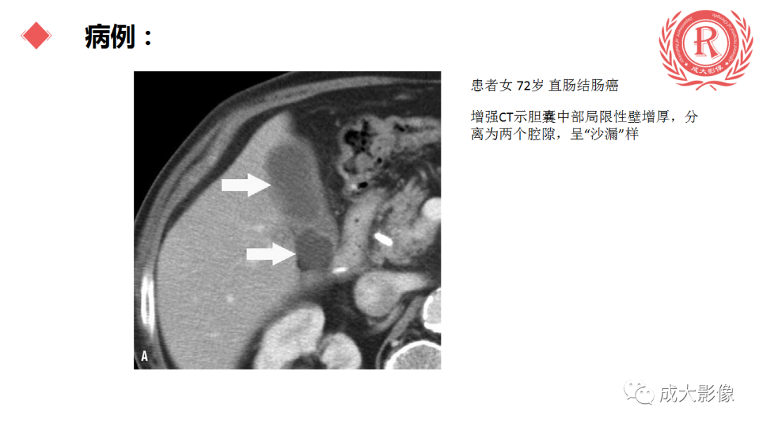 影像PPT - 【PPT】胆囊腺肌症-11
