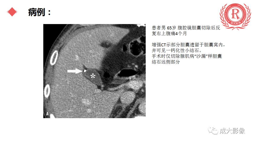 影像PPT - 【PPT】胆囊腺肌症-12
