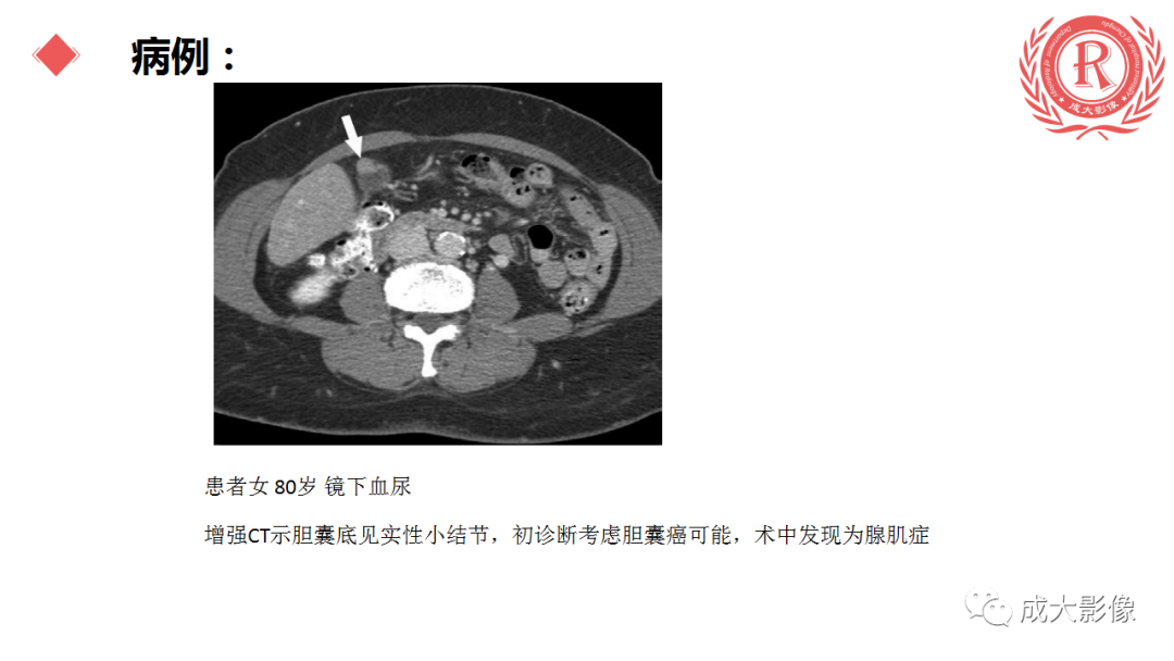 影像PPT - 【PPT】胆囊腺肌症-13