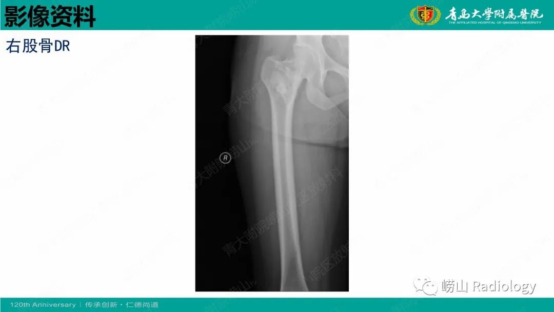 影像PPT - 【病例】脂肪硬化性黏液纤维性肿瘤1例X线CT及MR-4