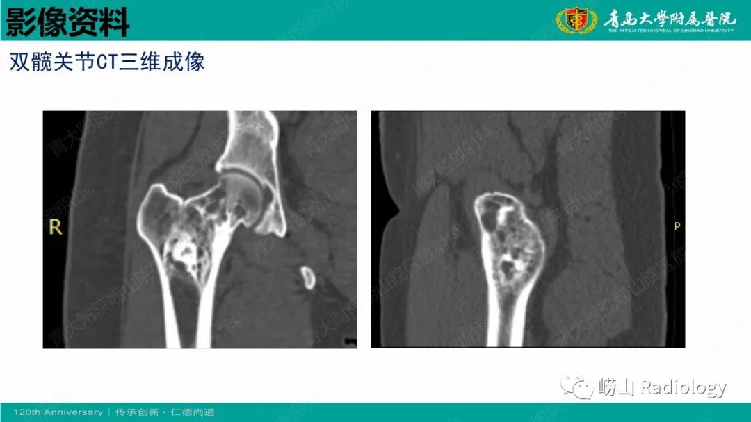 影像PPT - 【病例】脂肪硬化性黏液纤维性肿瘤1例X线CT及MR-6