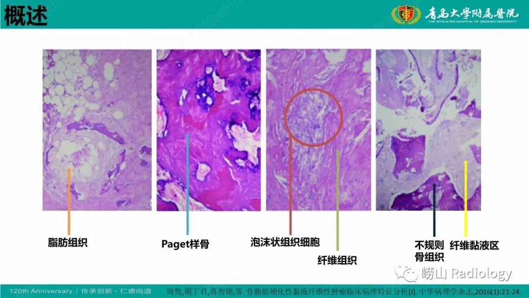 影像PPT - 【病例】脂肪硬化性黏液纤维性肿瘤1例X线CT及MR-13