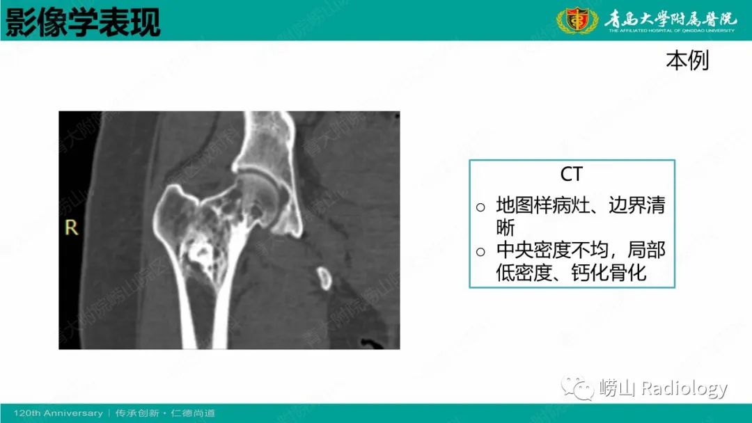 影像PPT - 【病例】脂肪硬化性黏液纤维性肿瘤1例X线CT及MR-15