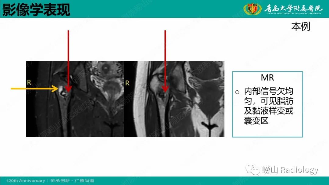 影像PPT - 【病例】脂肪硬化性黏液纤维性肿瘤1例X线CT及MR-16
