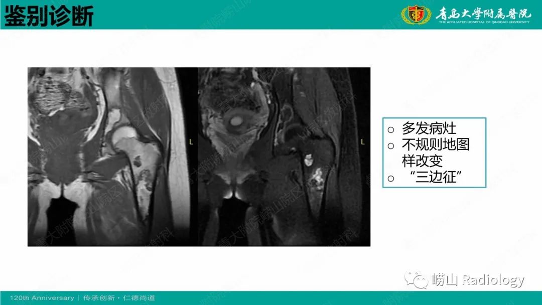 影像PPT - 【病例】脂肪硬化性黏液纤维性肿瘤1例X线CT及MR-22