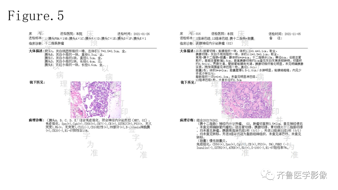 影像PPT - 【PPT】非功能性胰腺神经内分泌肿瘤-8