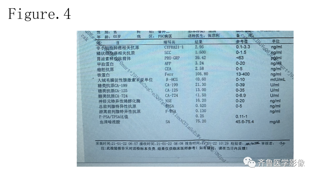 影像PPT - 【PPT】非功能性胰腺神经内分泌肿瘤-7