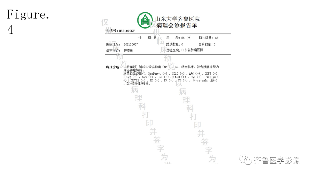 影像PPT - 【PPT】非功能性胰腺神经内分泌肿瘤-13