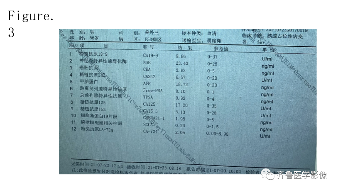 影像PPT - 【PPT】非功能性胰腺神经内分泌肿瘤-12
