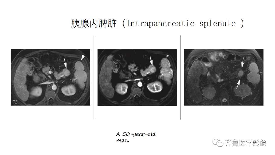 影像PPT - 【PPT】非功能性胰腺神经内分泌肿瘤-35