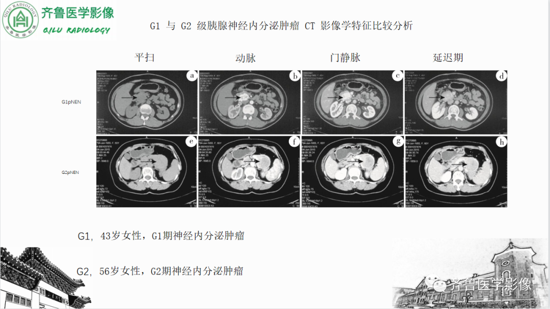 影像PPT - 【PPT】非功能性胰腺神经内分泌肿瘤-36