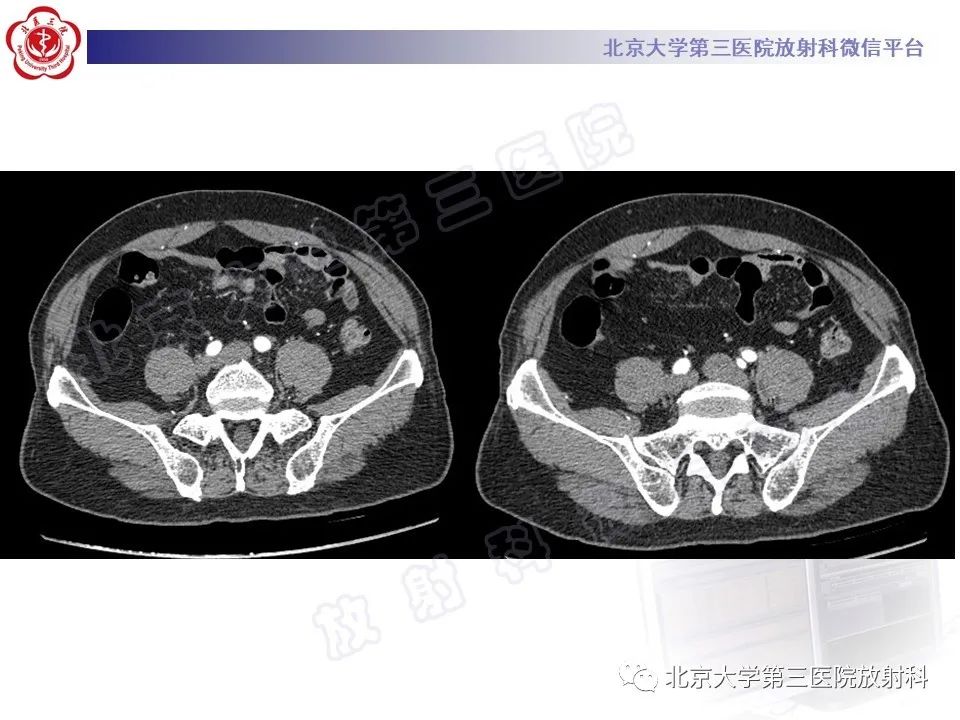 影像PPT - 【PPT】COCKETT综合征-4