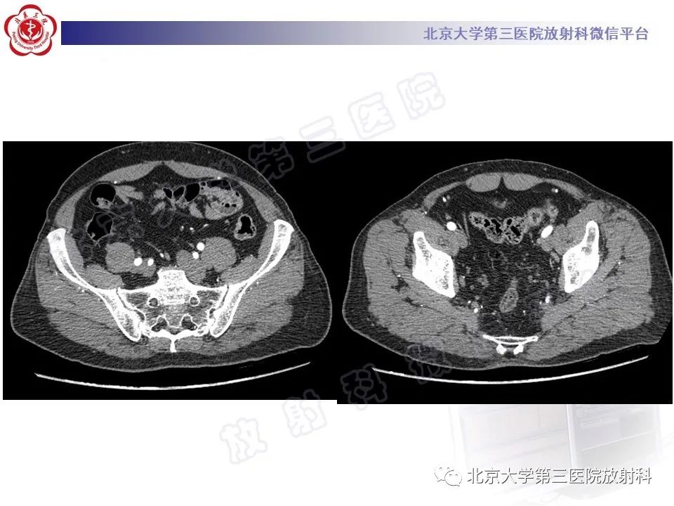 影像PPT - 【PPT】COCKETT综合征-5