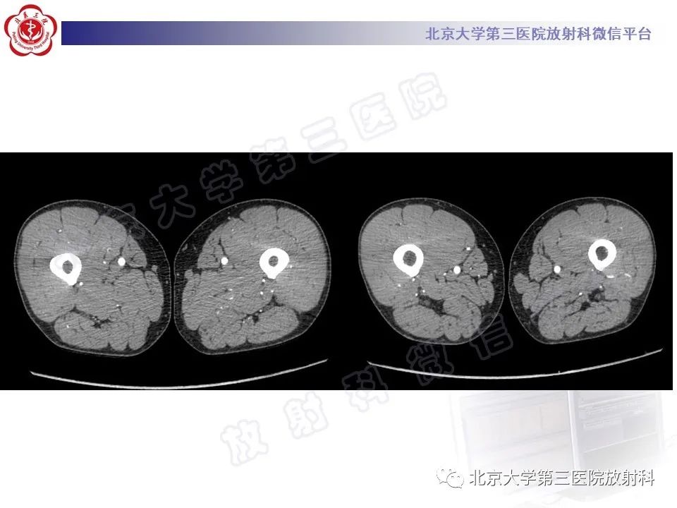 影像PPT - 【PPT】COCKETT综合征-6
