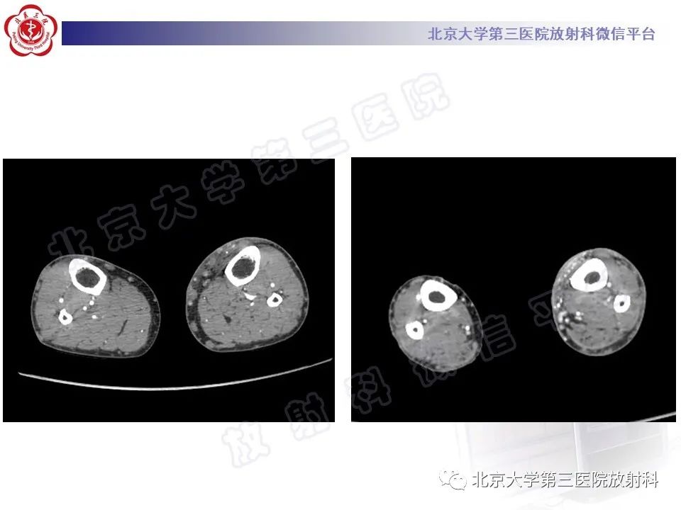 影像PPT - 【PPT】COCKETT综合征-7