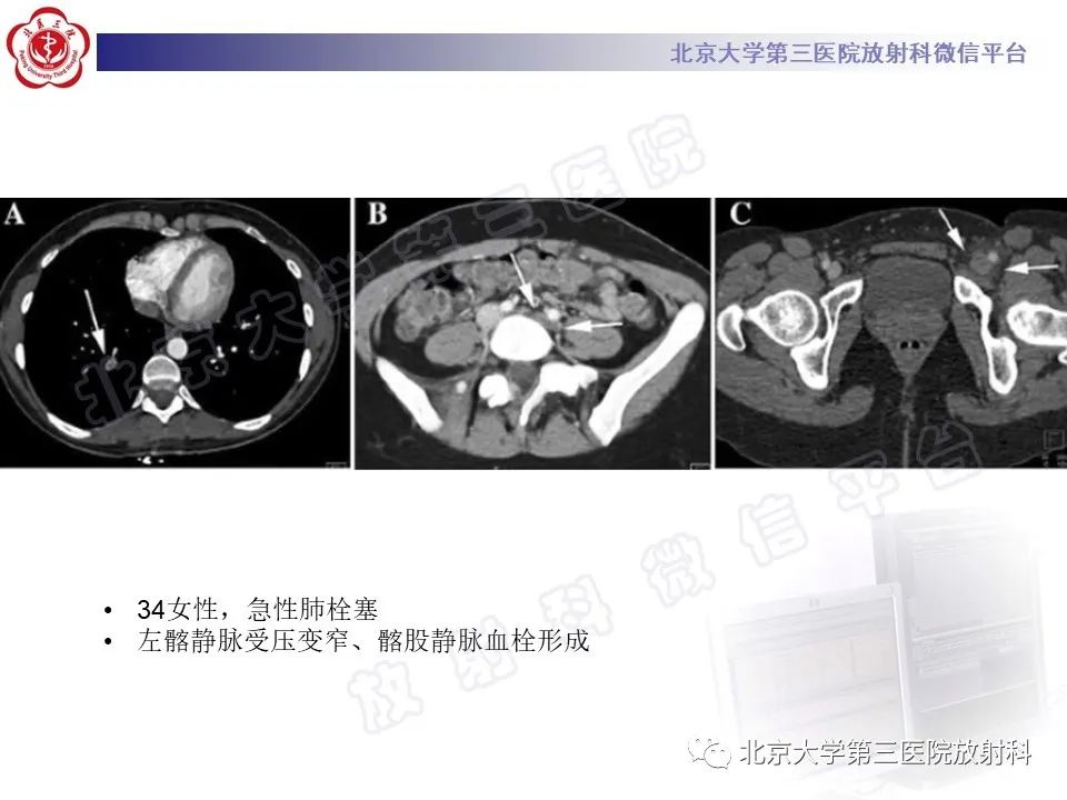 影像PPT - 【PPT】COCKETT综合征-20