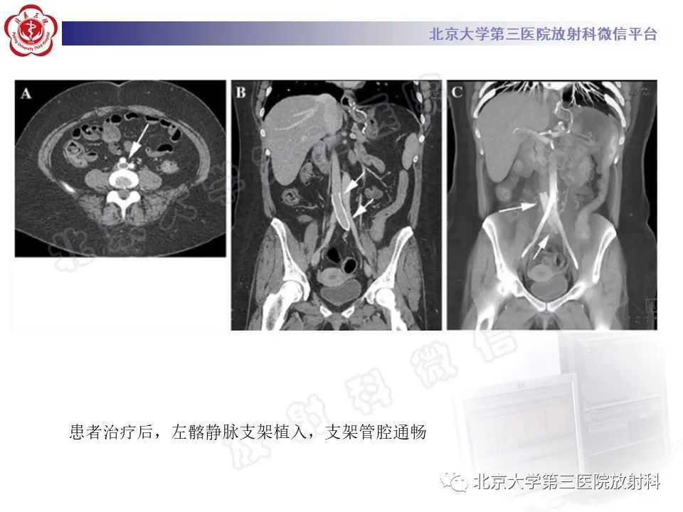 影像PPT - 【PPT】COCKETT综合征-21