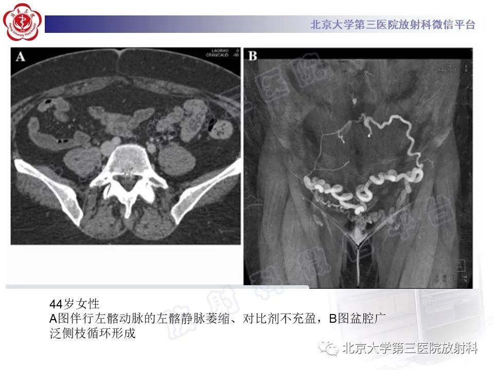 影像PPT - 【PPT】COCKETT综合征-22