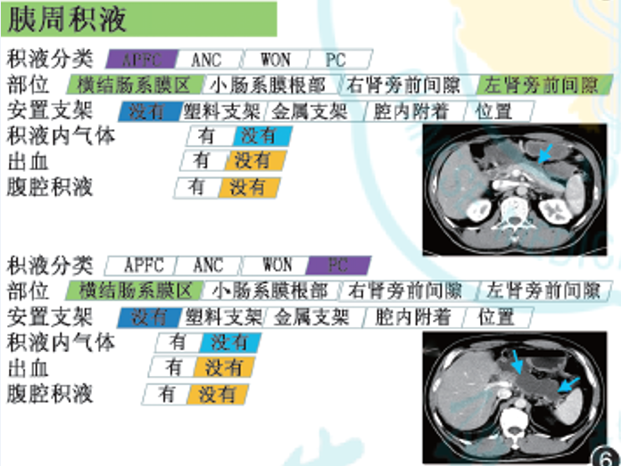 影像PPT - 急性胰腺炎国际结构化CT报告模板解读-7 影像PPT - 急性胰腺炎国际结构化CT报告模板解读-7