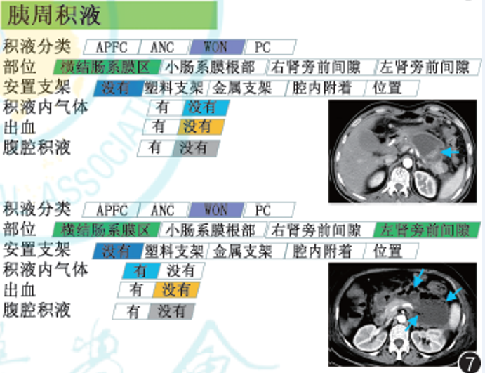 影像PPT - 急性胰腺炎国际结构化CT报告模板解读-8 影像PPT - 急性胰腺炎国际结构化CT报告模板解读-8