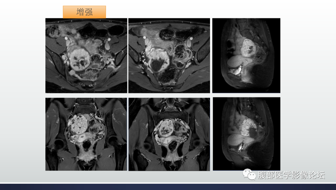 影像PPT - 【病例】卵巢罕见肿瘤Sertoli-Leydig细胞瘤1例MR影像-7