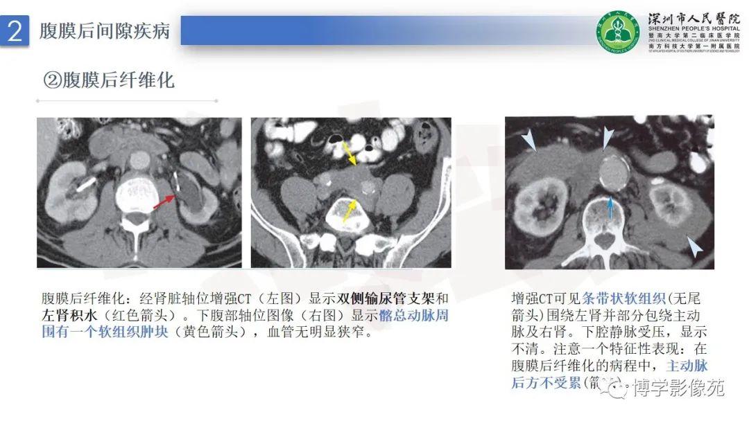 影像PPT - 【PPT】腹膜后间隙解剖及相关疾病-10