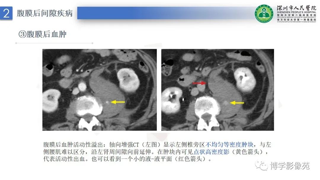 影像PPT - 【PPT】腹膜后间隙解剖及相关疾病-12