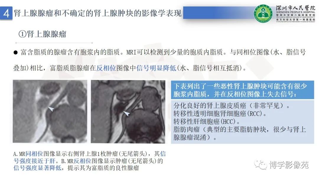 影像PPT - 【PPT】腹膜后间隙解剖及相关疾病-19
