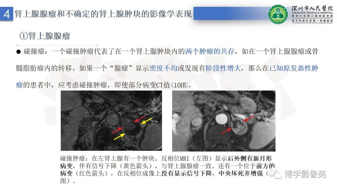 影像PPT - 【PPT】腹膜后间隙解剖及相关疾病-20