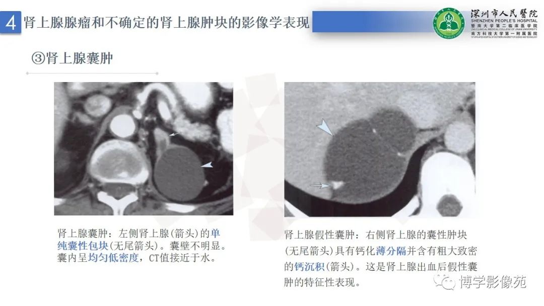 影像PPT - 【PPT】腹膜后间隙解剖及相关疾病-24