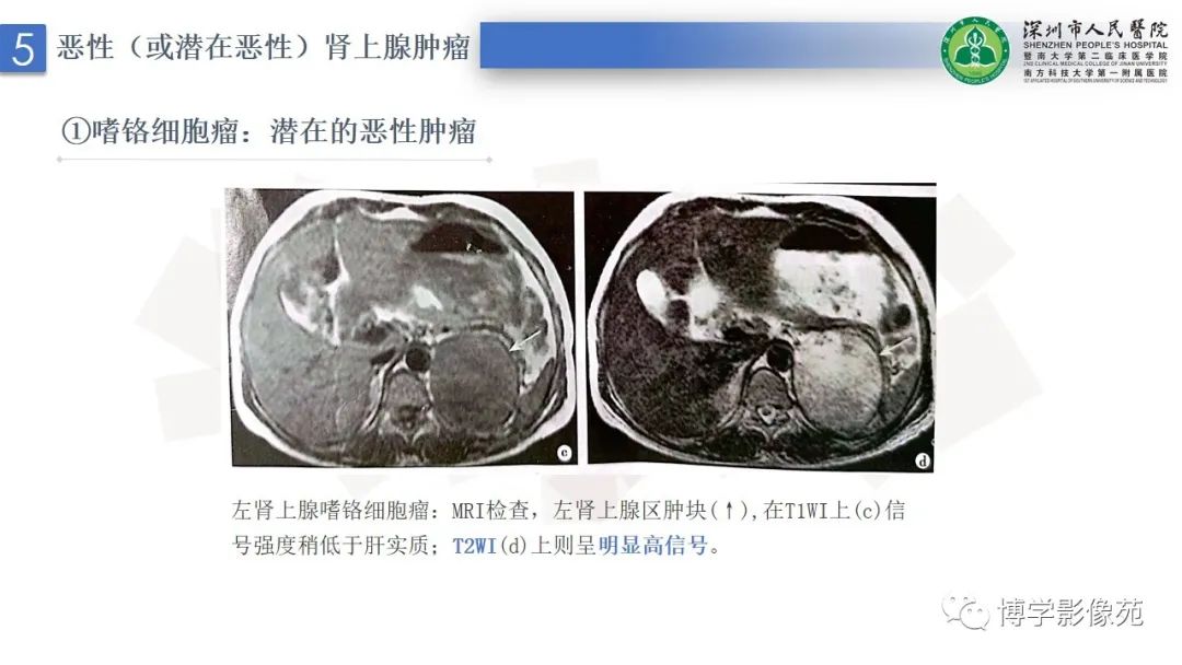 影像PPT - 【PPT】腹膜后间隙解剖及相关疾病-28