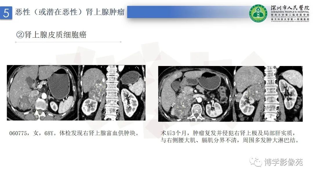 影像PPT - 【PPT】腹膜后间隙解剖及相关疾病-31