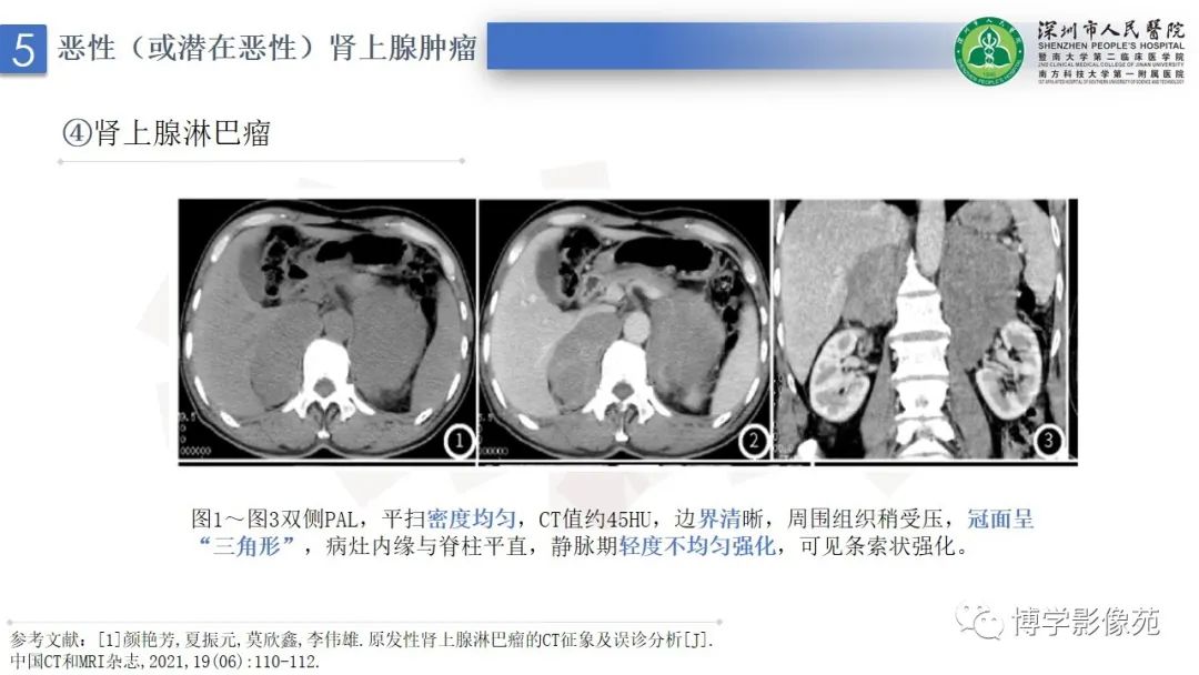 影像PPT - 【PPT】腹膜后间隙解剖及相关疾病-34