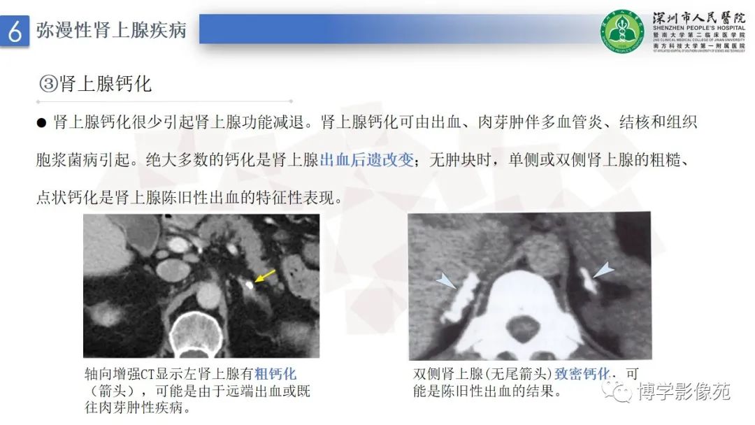 影像PPT - 【PPT】腹膜后间隙解剖及相关疾病-38