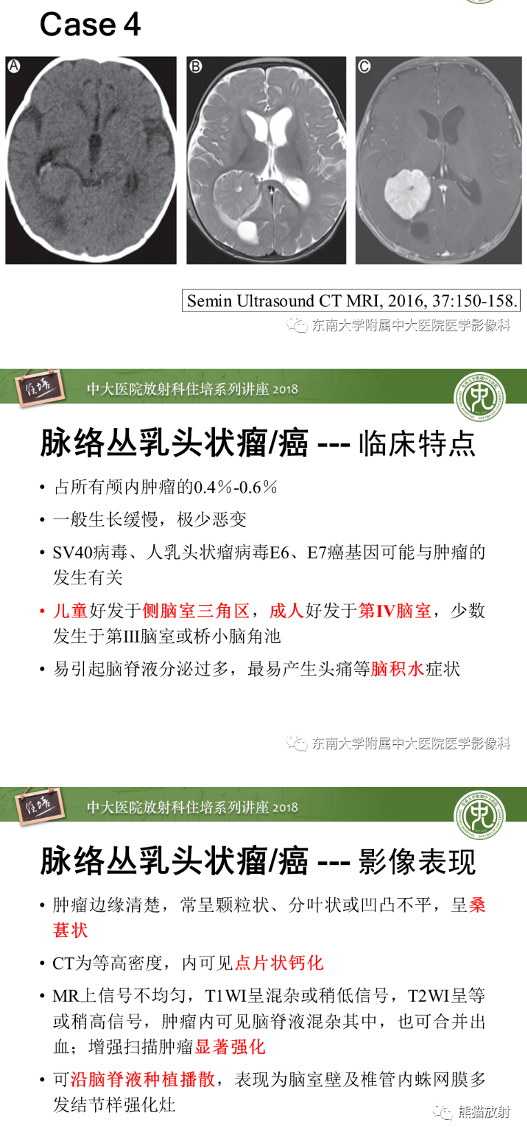 影像PPT - 【病例】侧脑室室管膜瘤1例MR影像表现-11