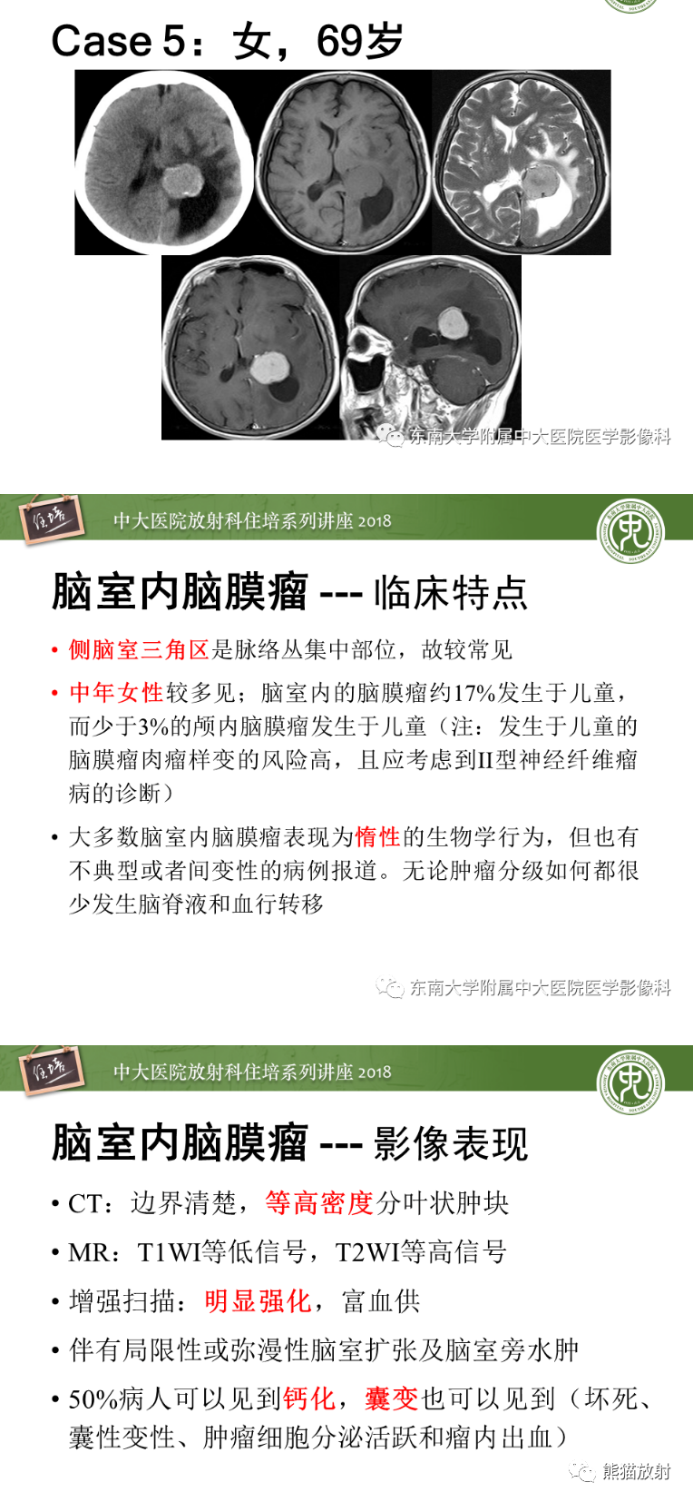 影像PPT - 【病例】侧脑室室管膜瘤1例MR影像表现-12